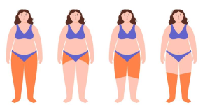 Jambes gonflées – 10 questions pour tout savoir sur le lipœdème