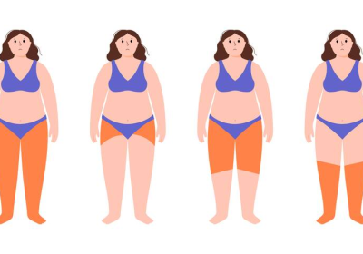 Jambes gonflées – 10 questions pour tout savoir sur le lipœdème